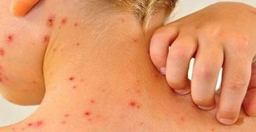 СЭРЭМЖЛҮҮЛЭГ: Менингококкт халдварын эрсдэл өндөр улирал эхэлж байна